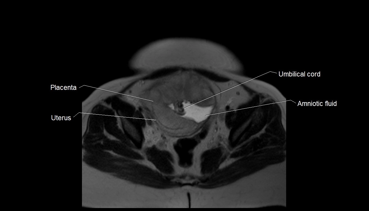 MRI fetal anatomy axial image 33.webp